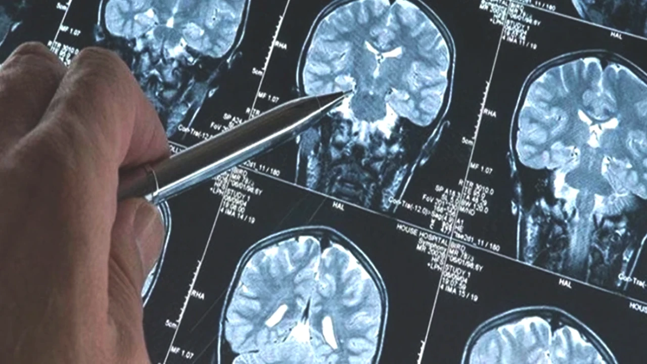 Alzheimer Tedavisinde Yeni Dönem! Leqembi ile Evde Uygulanabilir Çözüm
